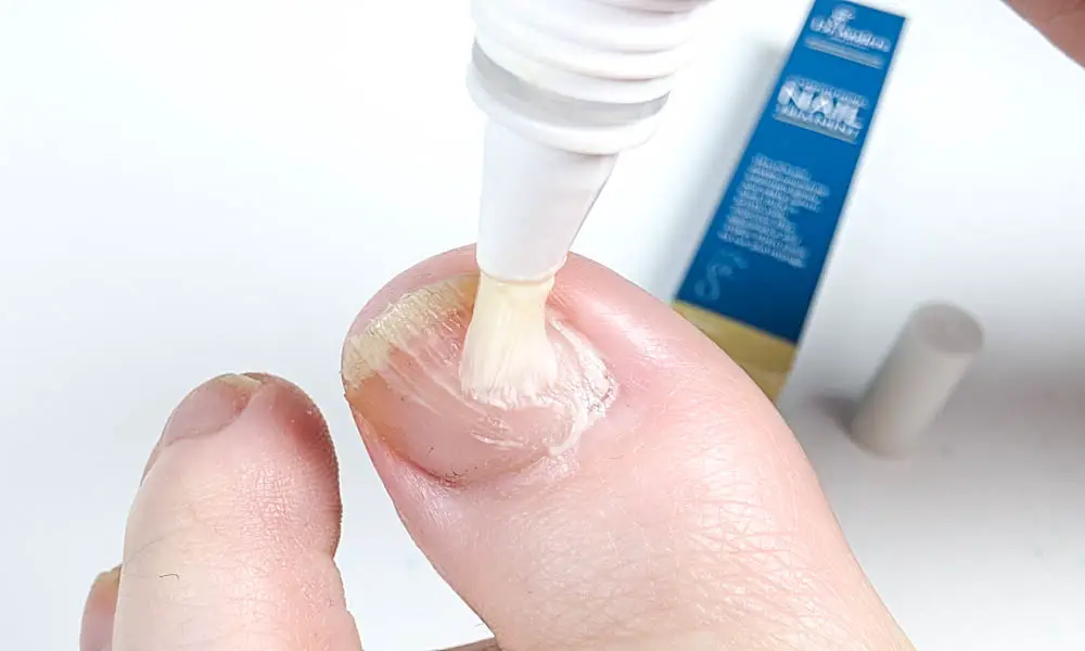 Dr Anders Nail Treatment being used