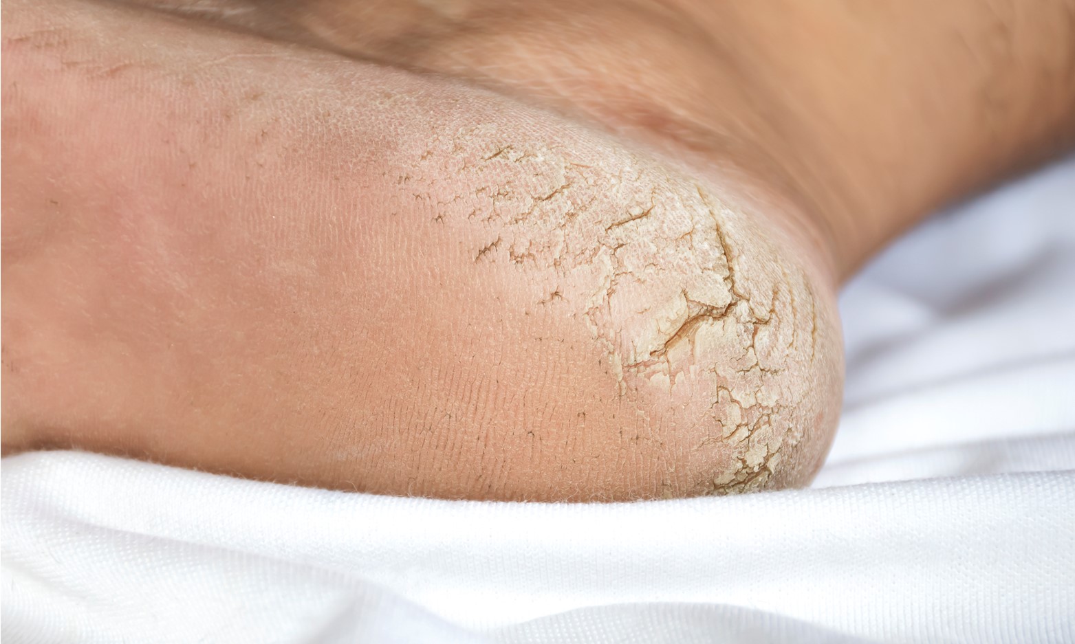 How Flexitol Foot Scrub can Help Hard Skin