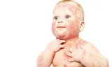 Top Tips for Managing Eczema